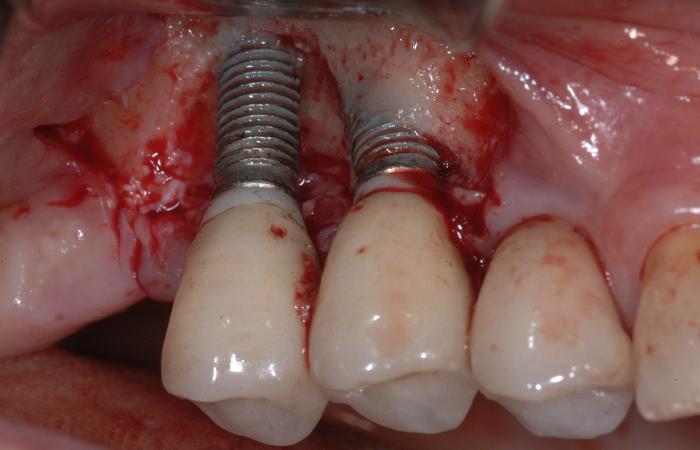 perimplantite