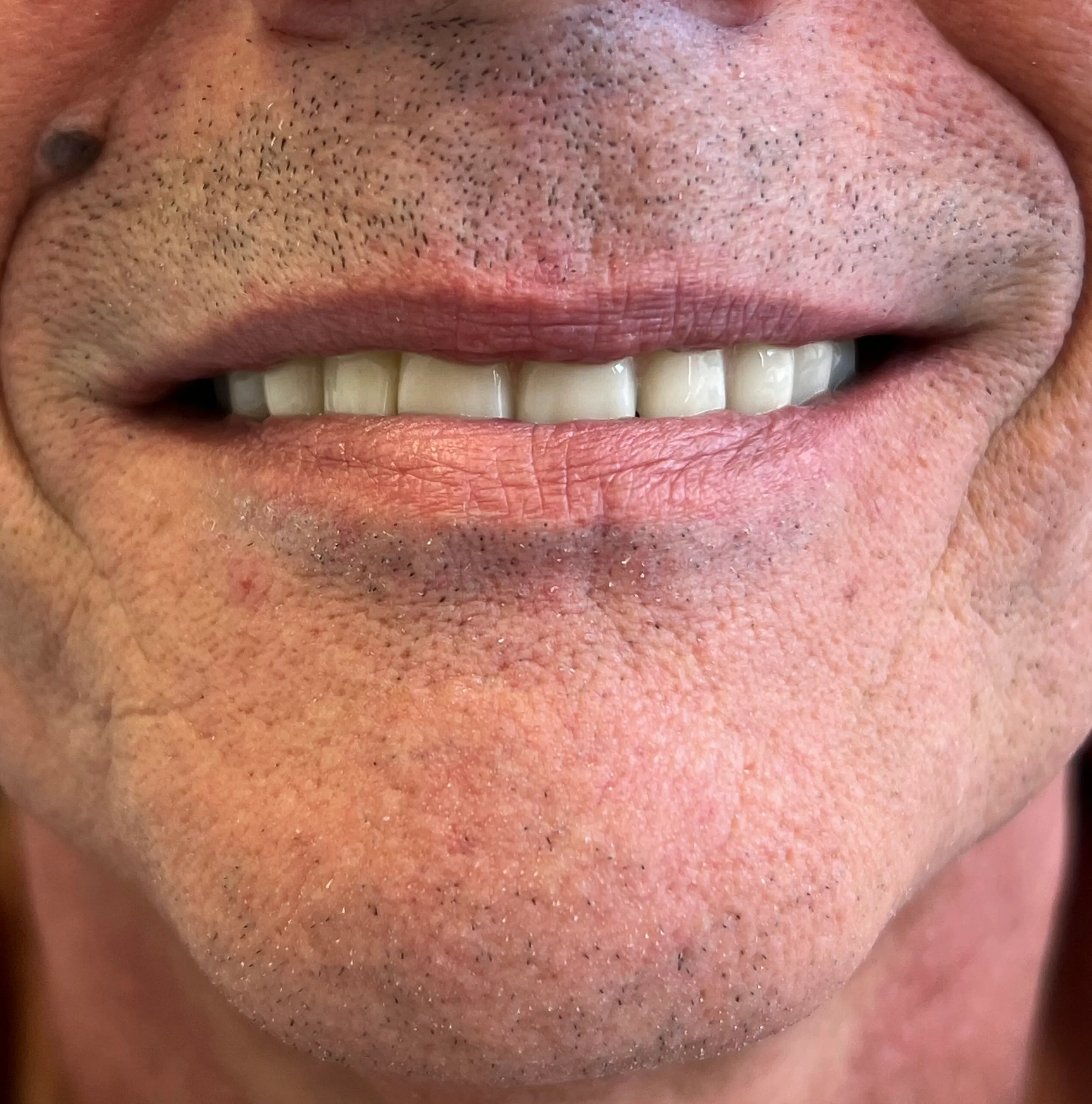 risultato-all-on-four-paziente