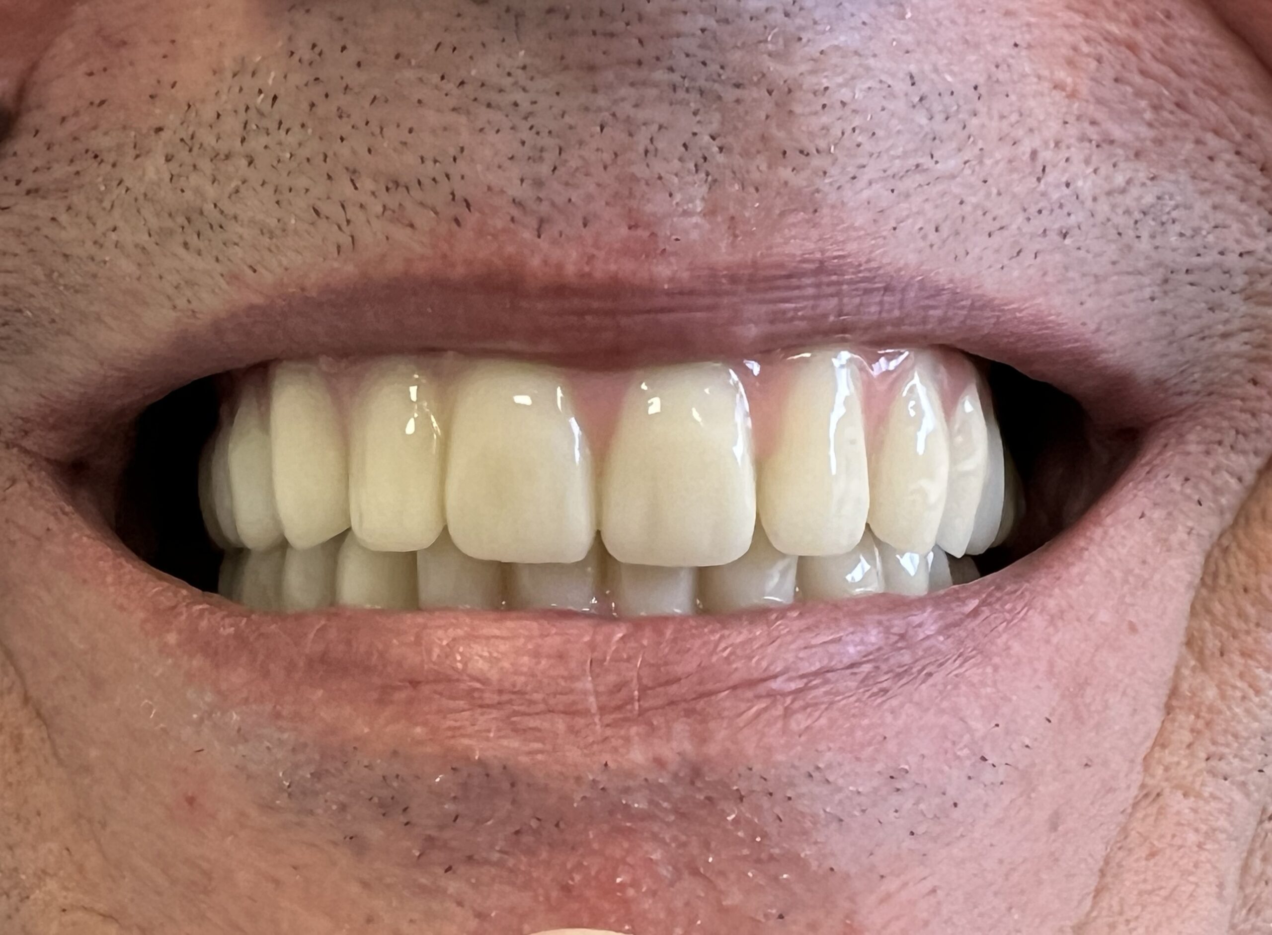 risultato-all-on-four-paziente